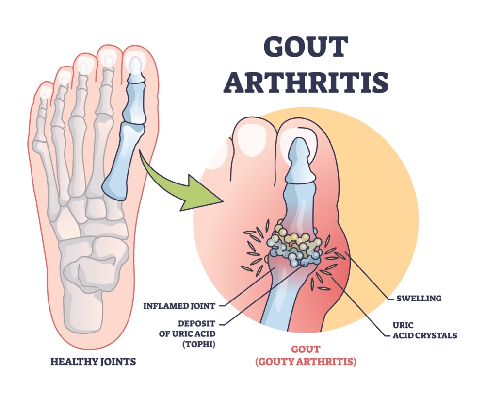 gout-arthritis