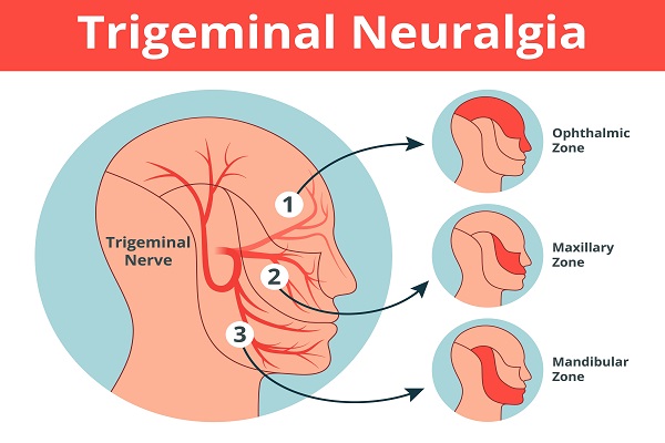 Treatments Available For Trigeminal Neuralgia