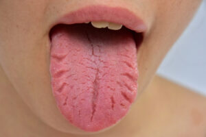 Tongue vertical crack