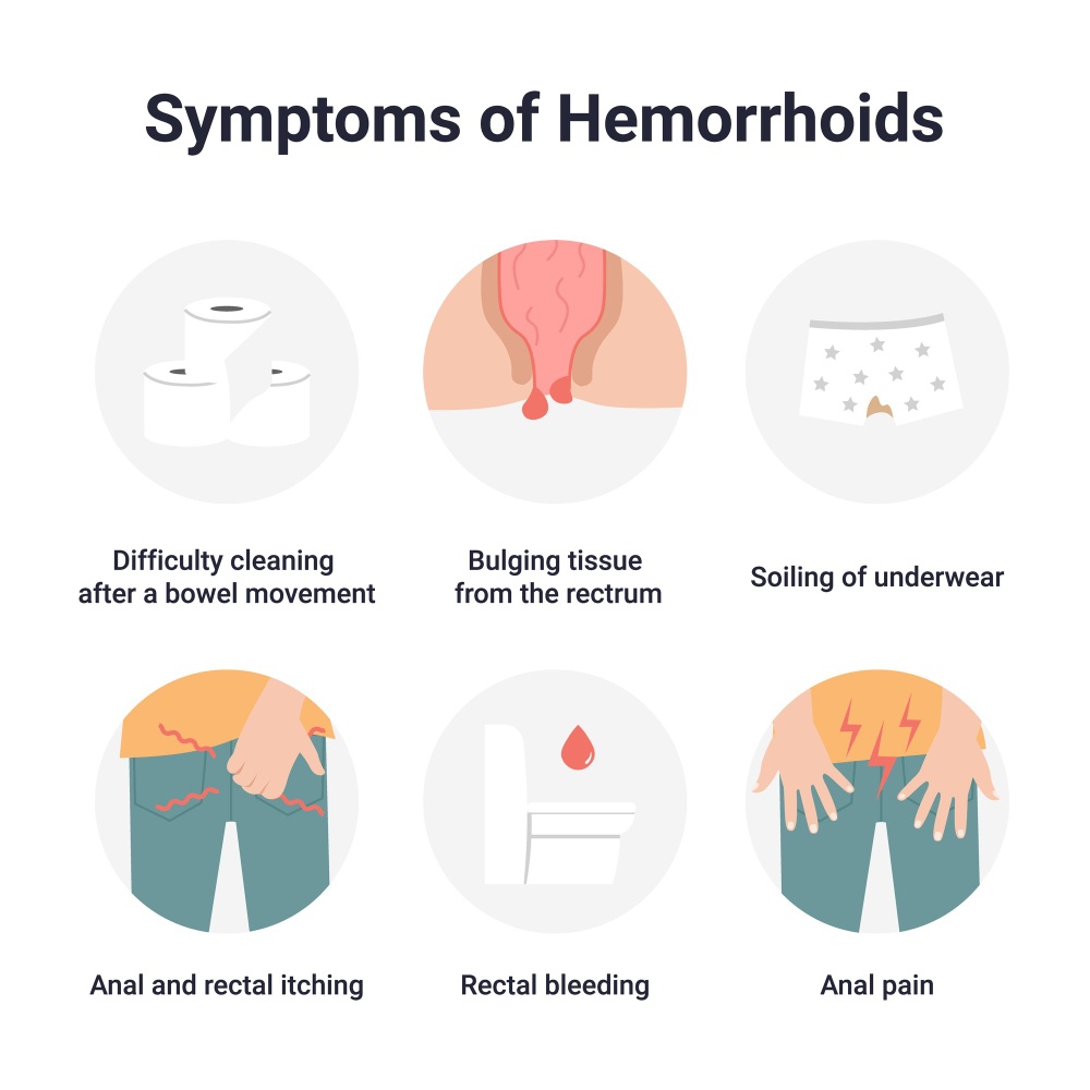 Hemorrhoids Symptoms