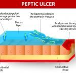 Advice for Ulcers and H. Pylori Infection