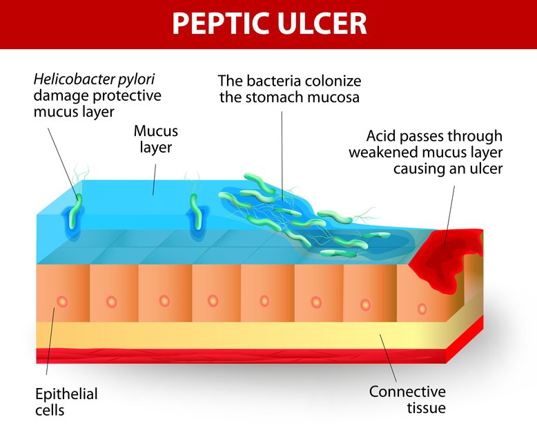 Read more about the article Advice for Ulcers and H. Pylori Infection