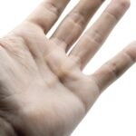 Dupuytren’s Contracture Starts with Lumps in Your Palms