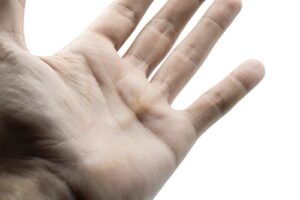 Dupuytren's contracture