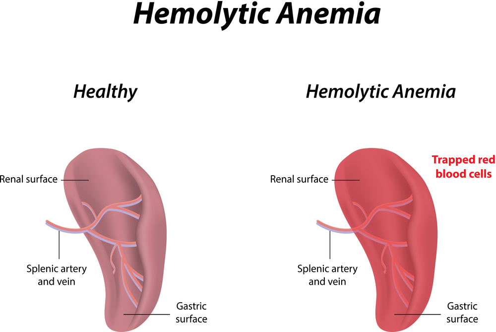 Hemolytic Anemia - What Color is Your Pee?