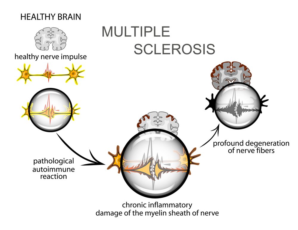 Intriguing Solutions for Multiple Sclerosis and Pain