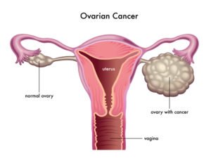 ovariancancer2