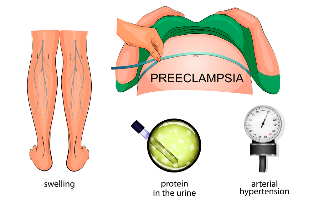 Preeclampsia Sx 1