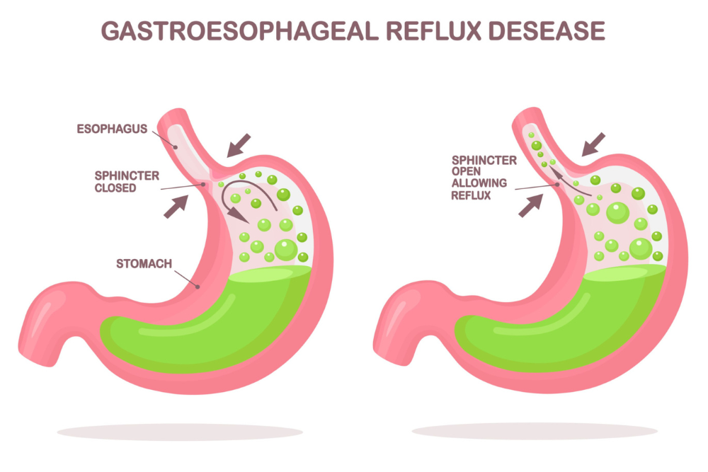 Reflux and Esophagitis Home Treatment