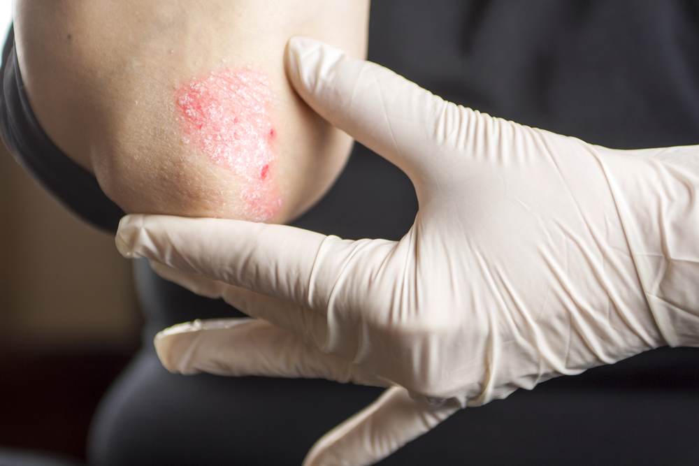 Read more about the article 10 Natural Remedies For Psoriasis & Eczema