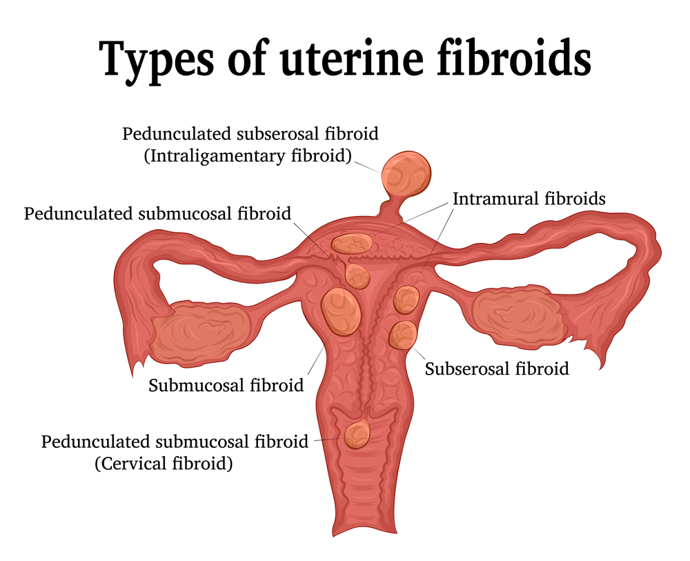 fibroids