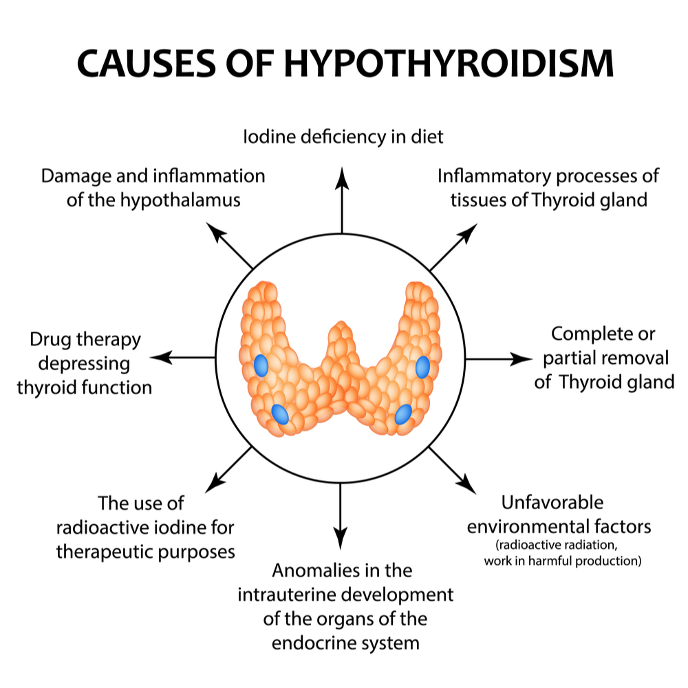 Causes of Hypothyroidism