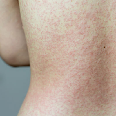 10 Novel Treatments for Chronic Itch, Eczema and Skin Infections - Suzy ...