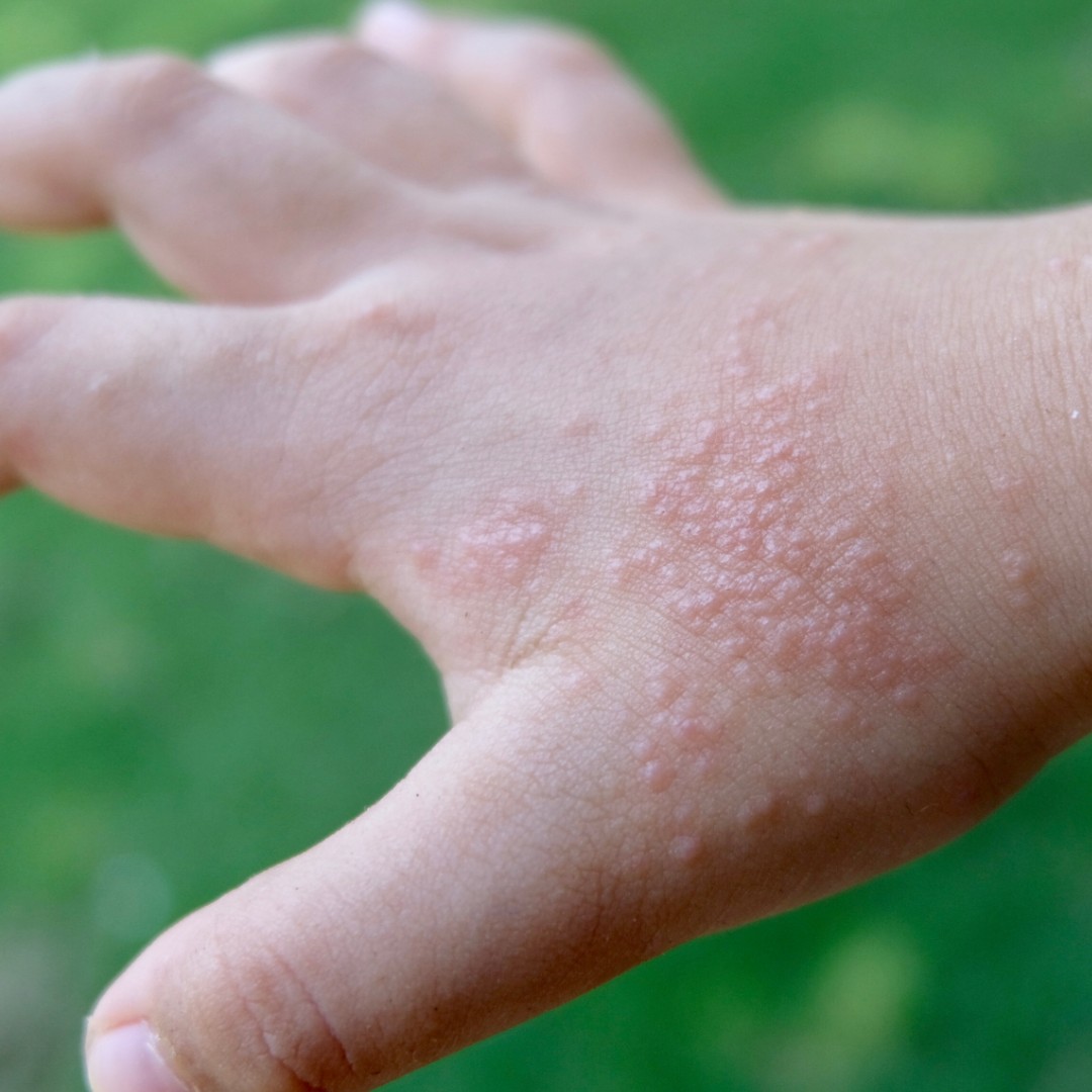 10 Novel Treatments for Chronic Itch, Eczema and Skin Infections Suzy