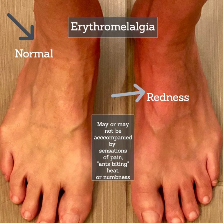 Small Fiber Neuropathy Causes and Treatment - Suzy Cohen, RPh offers ...