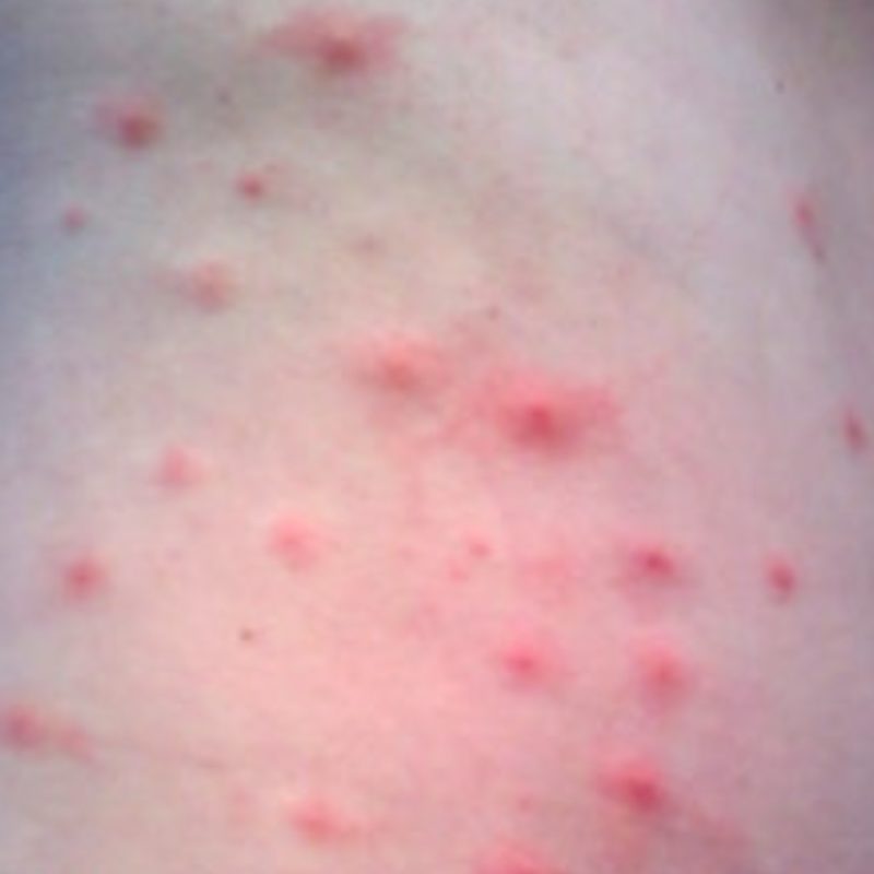 10 Novel Treatments for Chronic Itch, Eczema and Skin Infections - Suzy ...