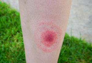 Image of bullseye rash from lyme disease