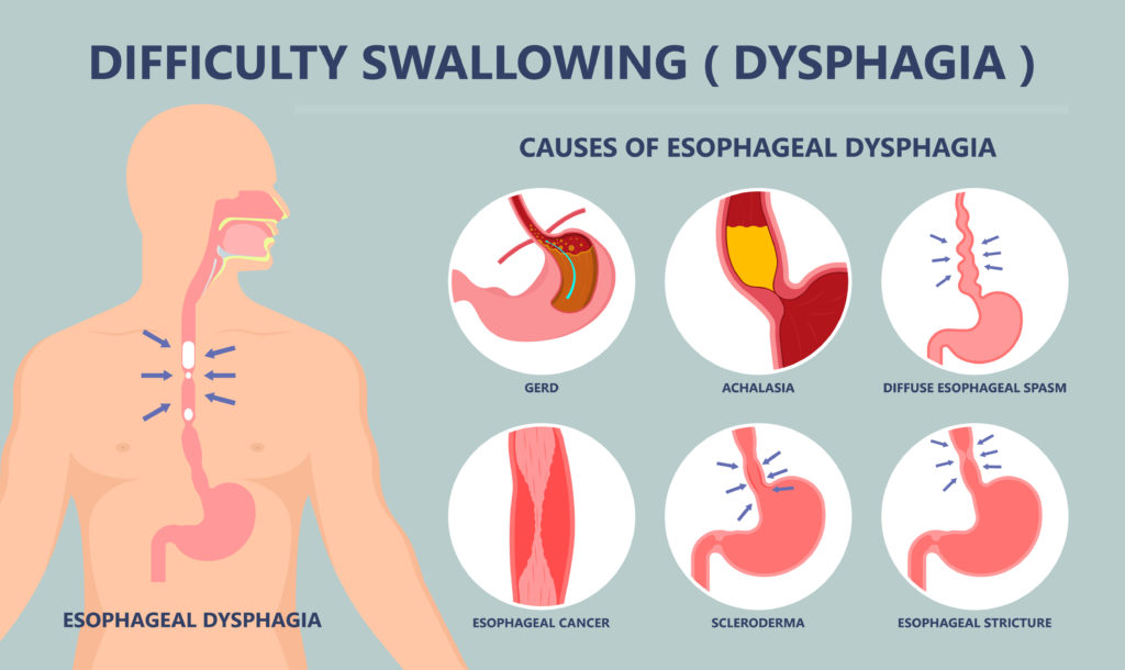 The Causes Of Esophageal Dysphagia In 2020 Dysphagia Dysphagia | Images ...