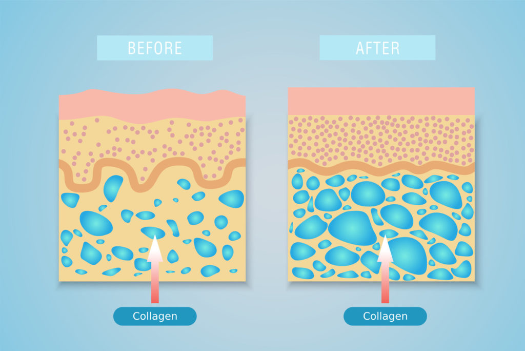collagen before and after