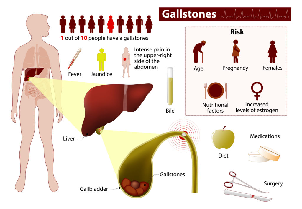 TUDCA and UDCA for Gallstones and SIBO