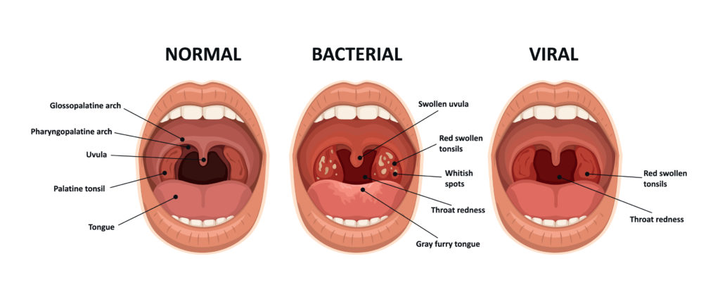 The difference between viral and bacterial sore throat