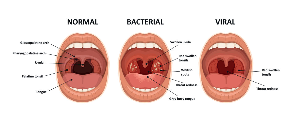 causes-and-treatments-for-sore-throat