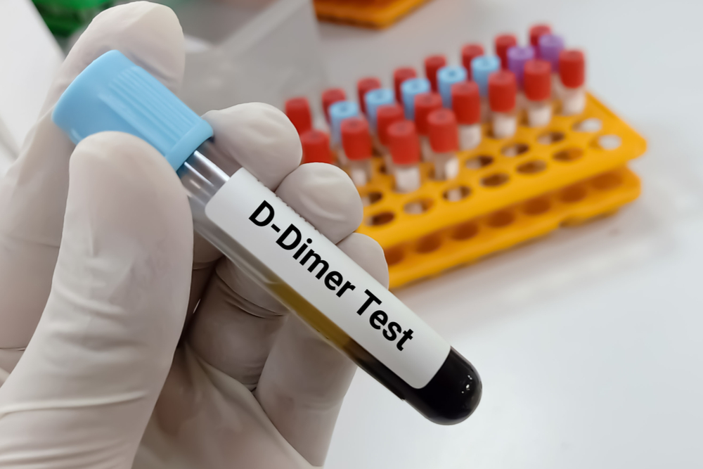 Read more about the article Understanding D-Dimer and 10 Strategies to Reduce It