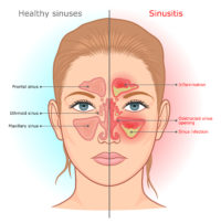 A Sinus Fungal Ball Causes Problems Galore - Suzy Cohen, RPh offers ...