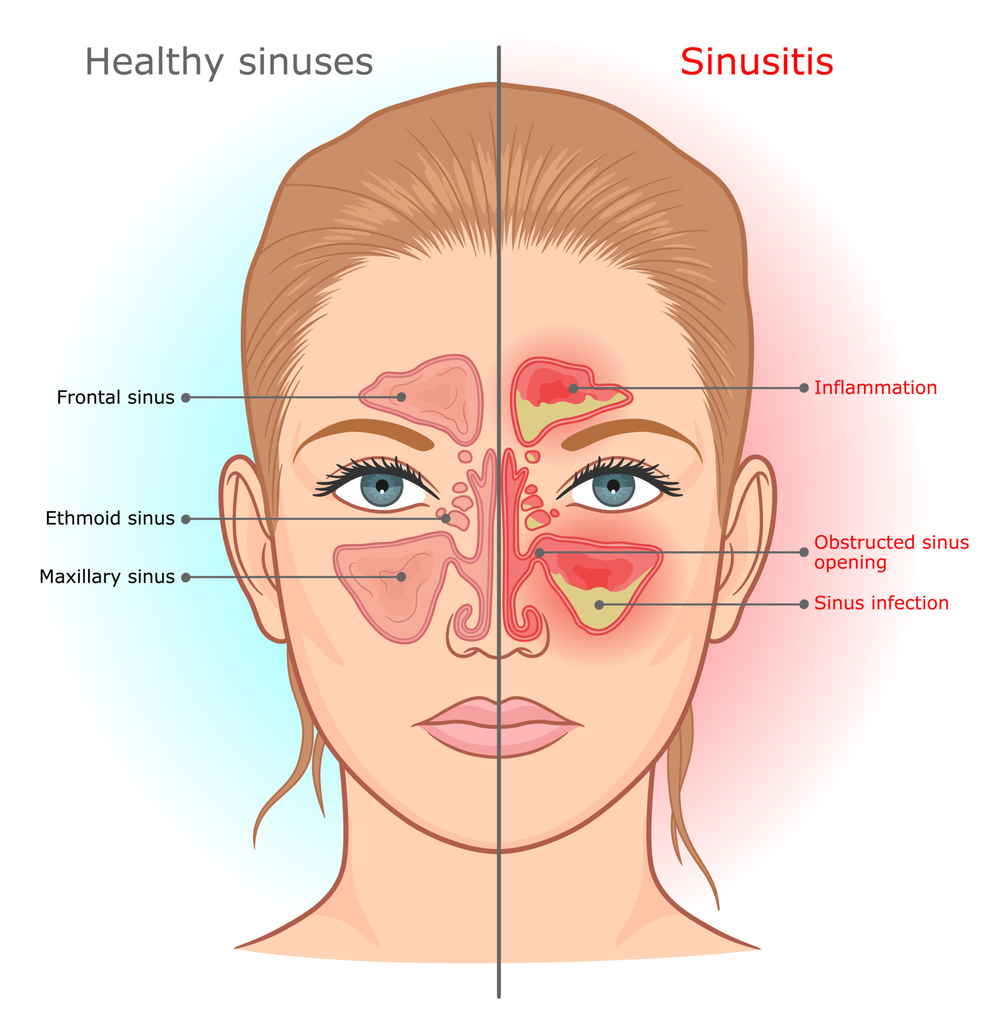 a-sinus-fungal-ball-causes-problems-galore-suzy-cohen-rph-offers