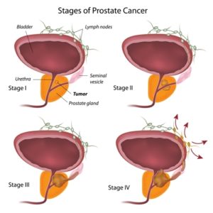 The 4 stages of Prostate Cancer Stage 1, 2, 3 and 4