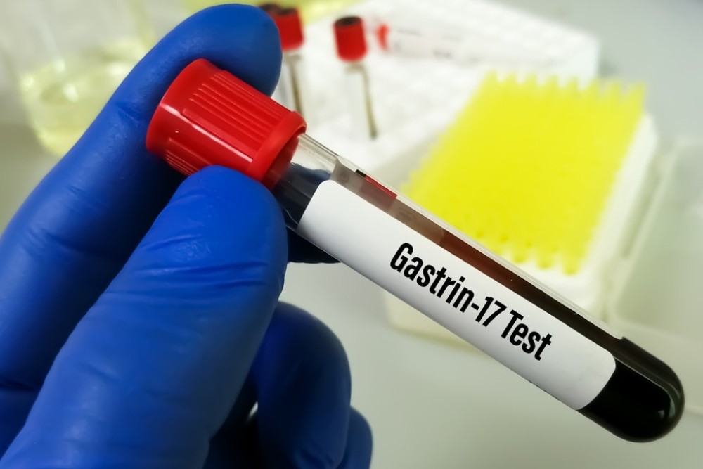 Why you should evaluate gastrin