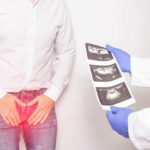 What You Should Test for in Prostate Cancer