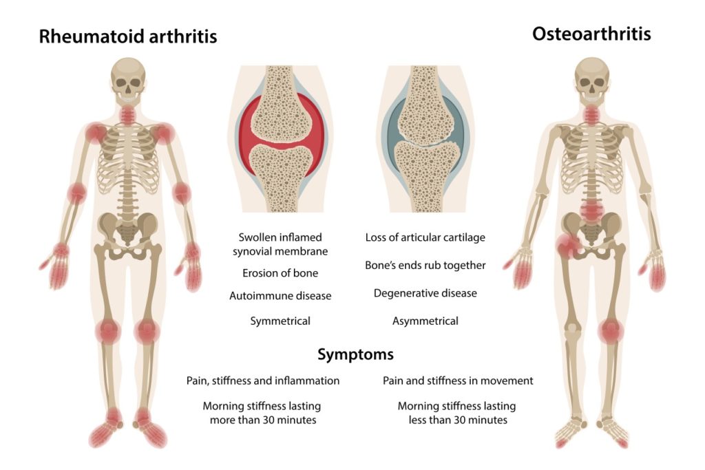 rheumatoid osteoarthritis 