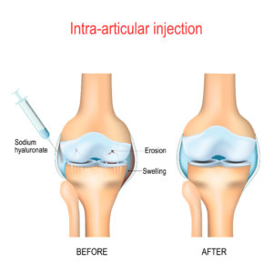 hyaluronicacid knee arthritis