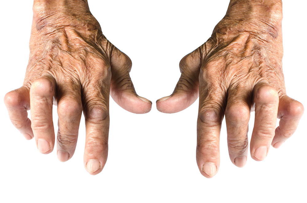 Read more about the article 5 Natural Strategies for Rheumatoid Arthritis Pain
