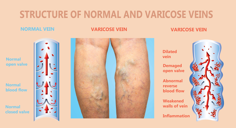 Read more about the article Natural Remedies For Varicose And Spider Veins