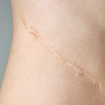 The 6 Best Ways to Get Rid of Scars