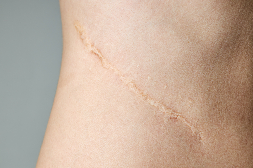 Read more about the article The 6 Best Ways to Get Rid of Scars