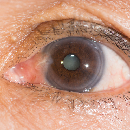 Close-up of Cataract