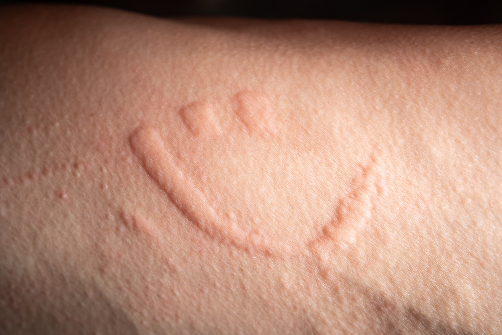 Read more about the article Dermatographia, Causes, Risk Factors and 7 Potential Treatments