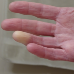 7 Holistic Approaches to Managing Raynaud’s Phenomenon