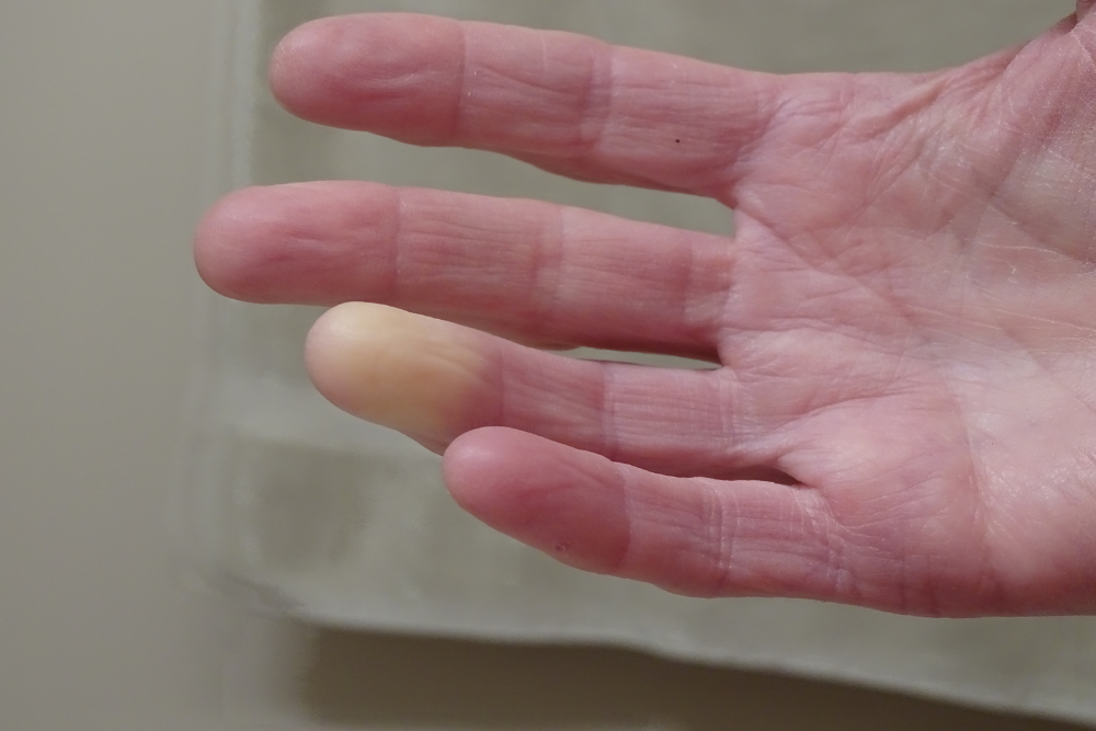 Read more about the article 7 Holistic Approaches to Managing Raynaud’s Phenomenon