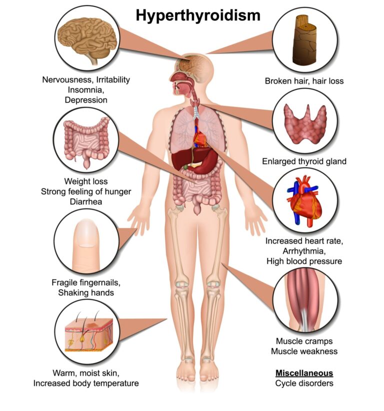 10 Key Symptoms of Hyperthyroidism: Understanding the Overactive ...