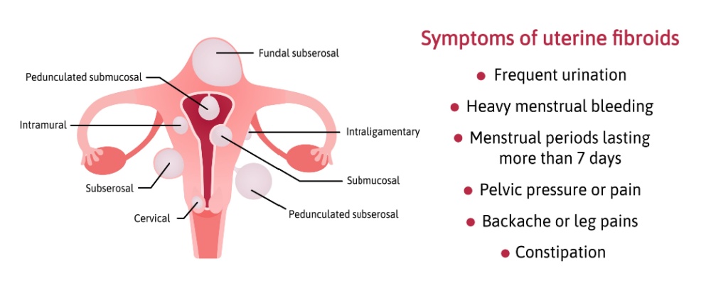 Fibroids Symptoms