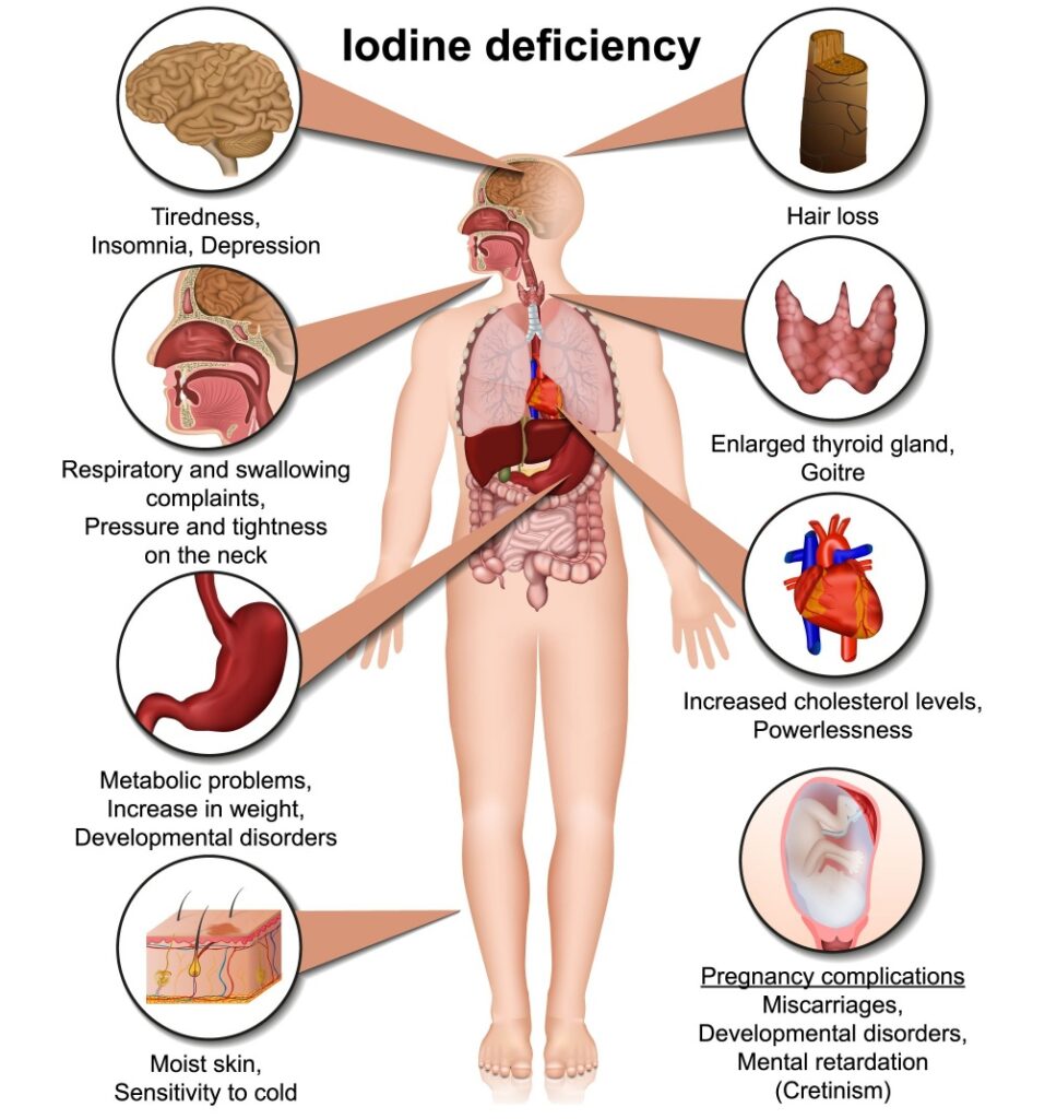 Iodine deficiency