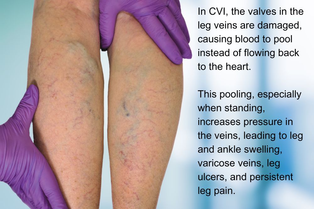 Image of legs with chronic venous insuffiency