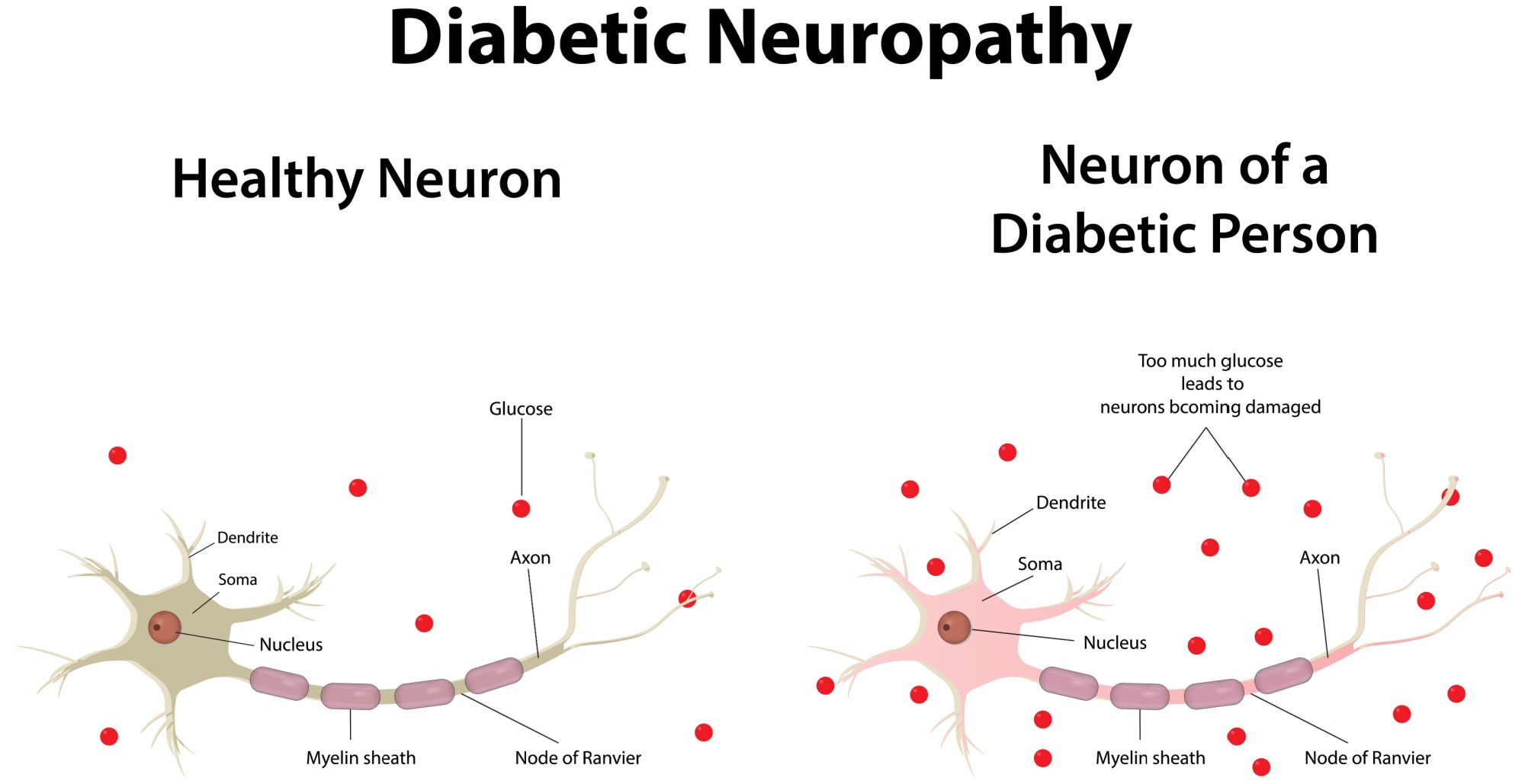 diabetic nerve pain