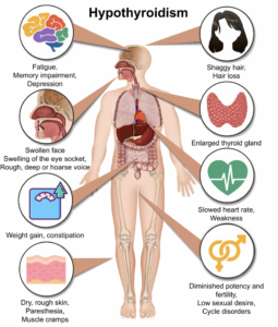 hypothyroidism symptoms