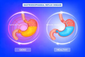 Concept Gastroesophageal Reflux Disease-GERD