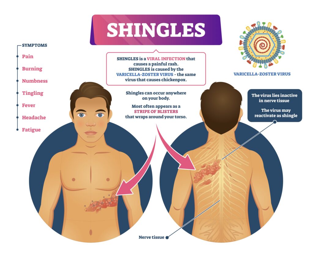 symptoms of shingles 